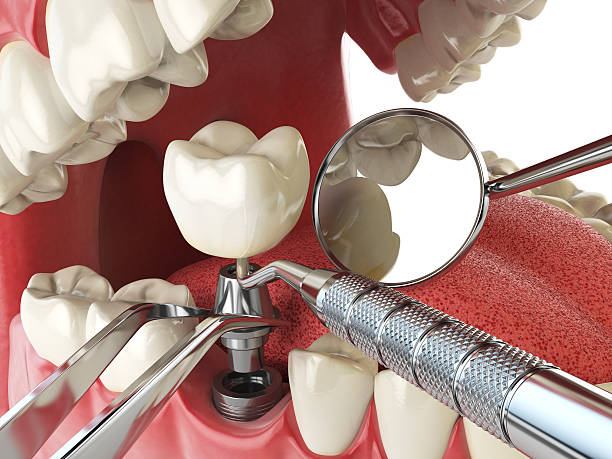 Best Emergency Dentist for Lost Fillings or Crowns in Pleasant Hills, PA